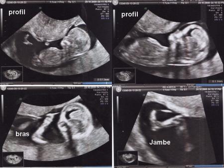 Echographie du 1er trimestre le 28 octobre 2008